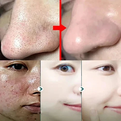 Green Mask - Acne & Pore Care